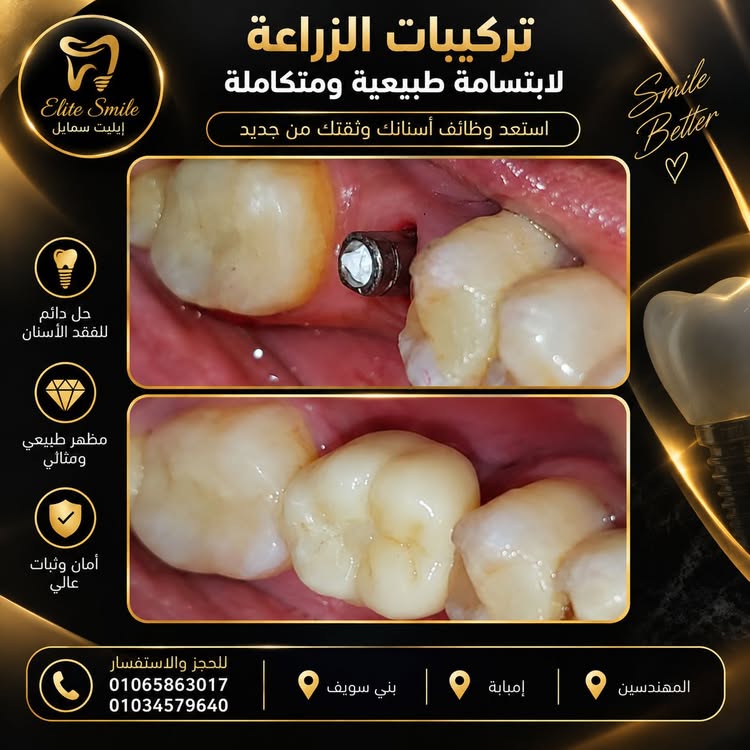 حالة تركيبات زراعة الأسنان - إيليت سمايل